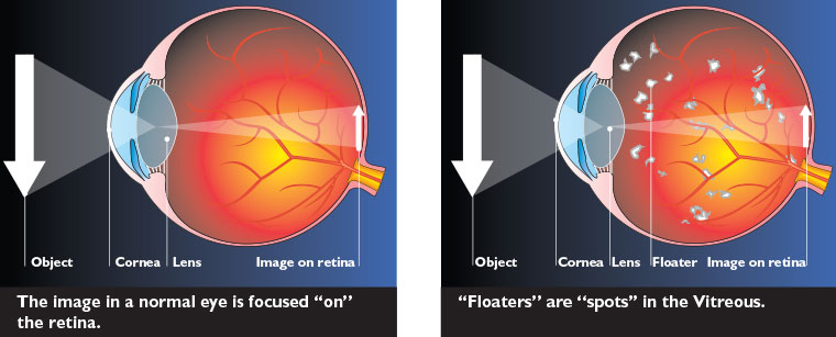 What Causes Sparkling Lights In Your Eyes Homeminimalisite